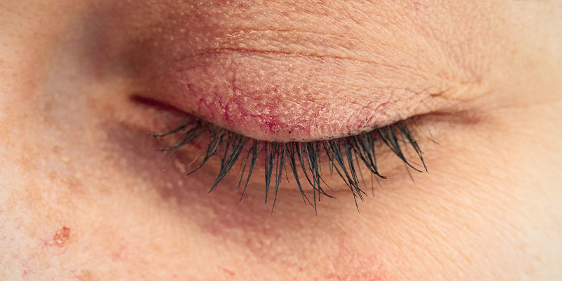 ¿Qué Hacer Cuando La Quemazón De Guindilla Te Afecta A Los Ojos?